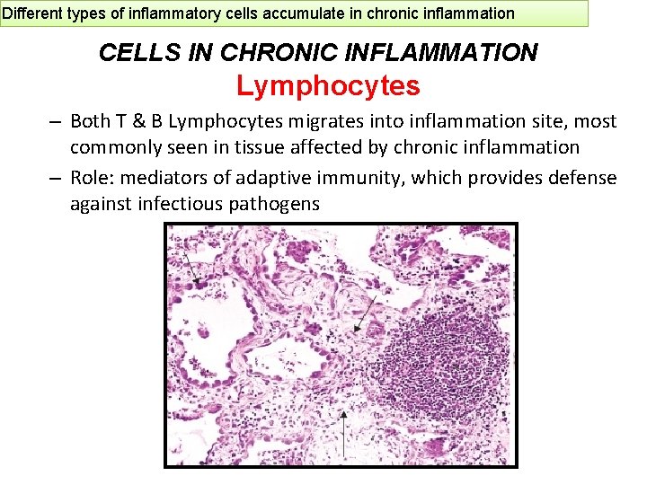 Different types of inflammatory cells accumulate in chronic inflammation CELLS IN CHRONIC INFLAMMATION Lymphocytes