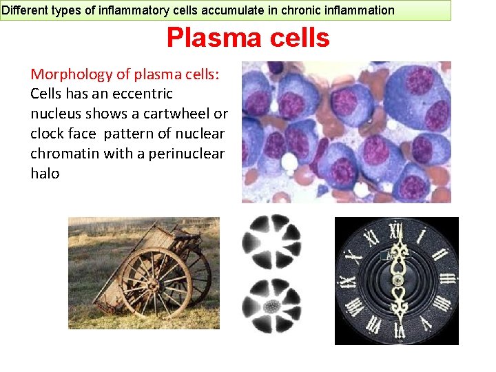 Different types of inflammatory cells accumulate in chronic inflammation Plasma cells Morphology of plasma