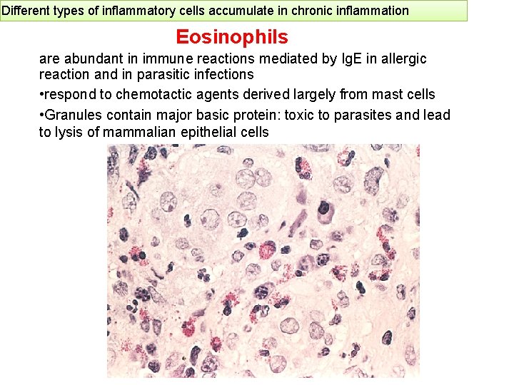 Different types of inflammatory cells accumulate in chronic inflammation Eosinophils are abundant in immune