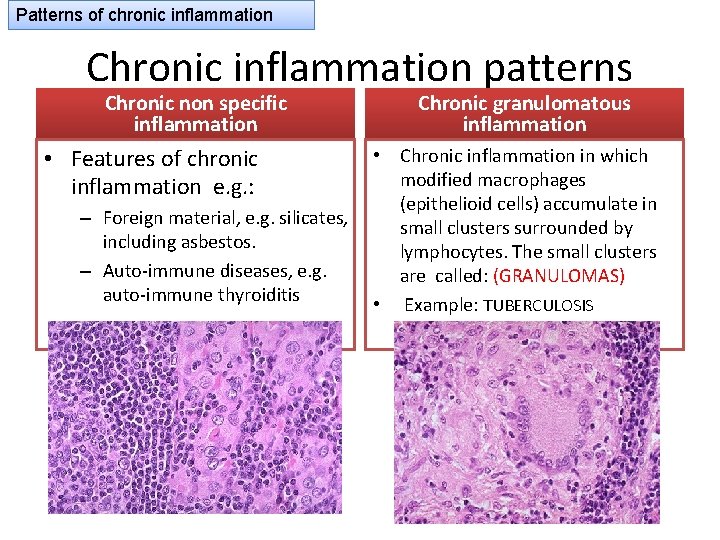 Patterns of chronic inflammation Chronic inflammation patterns Chronic non specific inflammation • Features of