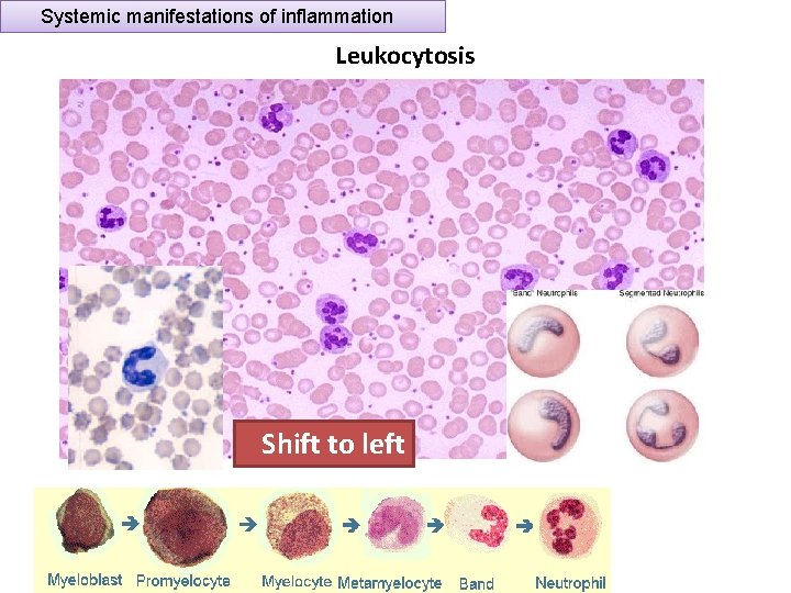 Systemic manifestations of inflammation Leukocytosis Shift to left 