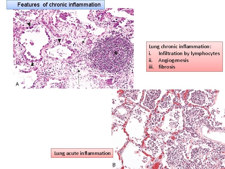 Features of chronic inflammation Lung chronic inflammation: i. Infiltration by lymphocytes ii. Angiogenesis iii.