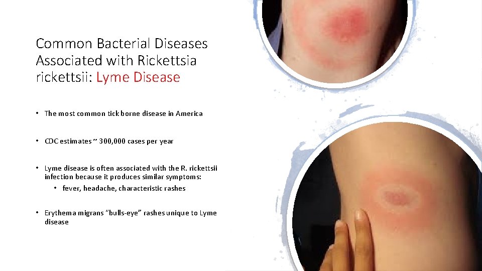 Common Bacterial Diseases Associated with Rickettsia rickettsii: Lyme Disease • The most common tick