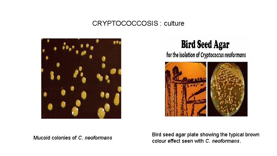 CRYPTOCOCCOSIS : culture Mucoid colonies of C. neoformans Bird seed agar plate showing the
