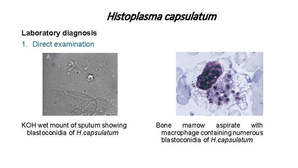 Histoplasma capsulatum Laboratory diagnosis 1. Direct examination KOH wet mount of sputum showing blastoconidia