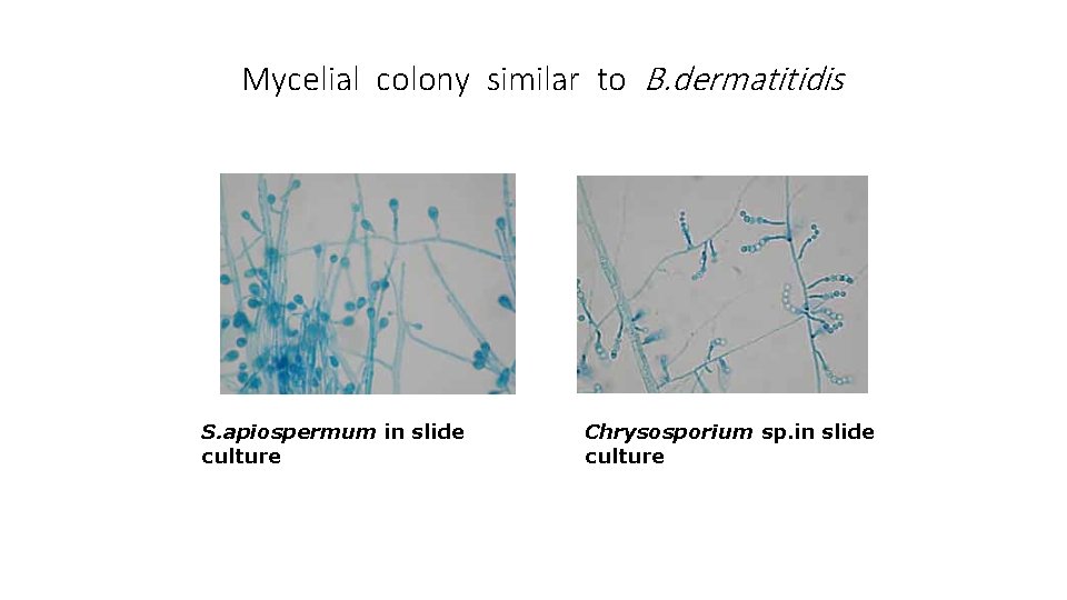 Mycelial colony similar to B. dermatitidis S. apiospermum in slide culture Chrysosporium sp. in