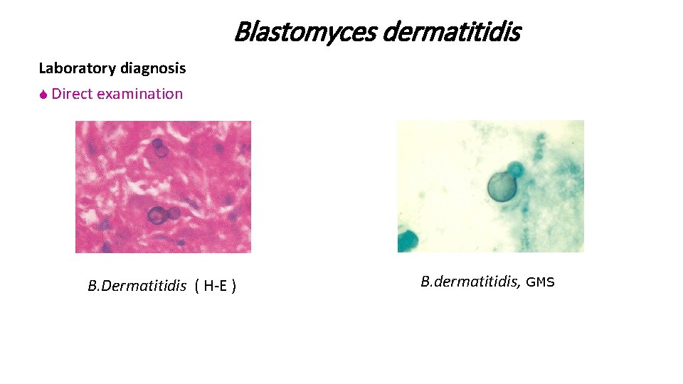 Blastomyces dermatitidis Laboratory diagnosis S Direct examination B. Dermatitidis ( H-E ) B. dermatitidis,