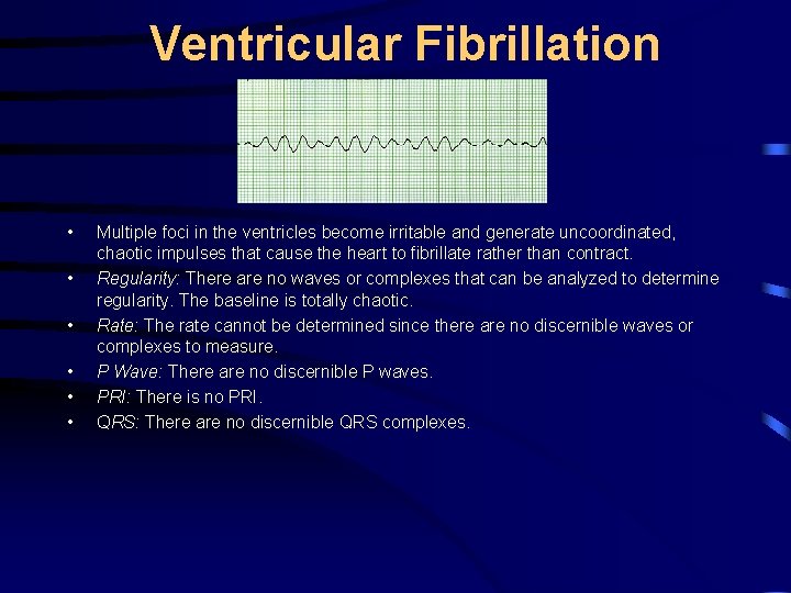 Ventricular Fibrillation • • • Multiple foci in the ventricles become irritable and generate