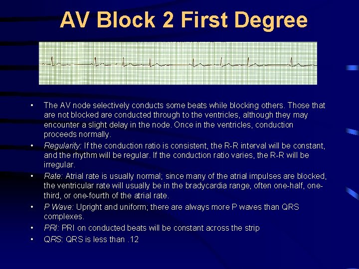 AV Block 2 First Degree • • • The AV node selectively conducts some
