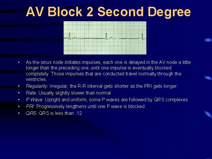 AV Block 2 Second Degree • • • As the sinus node initiates impulses,