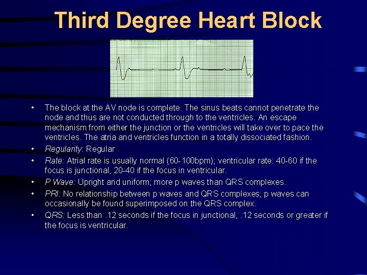 Third Degree Heart Block • • • The block at the AV node is