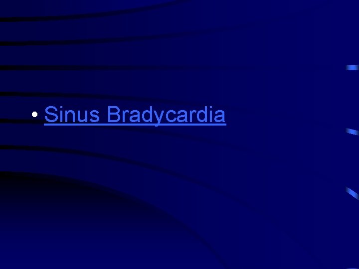  • Sinus Bradycardia 
