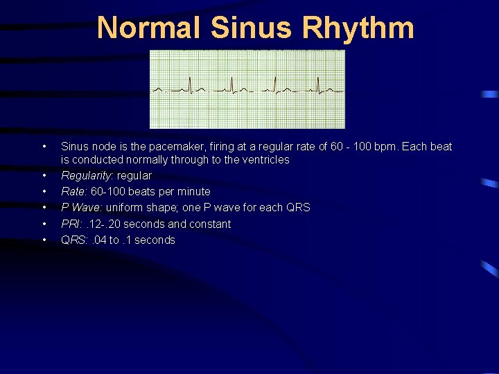 Normal Sinus Rhythm • • • Sinus node is the pacemaker, firing at a