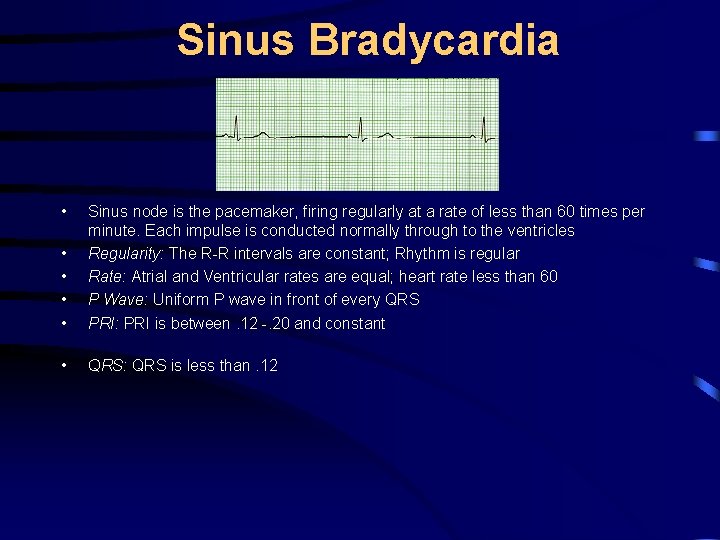 Sinus Bradycardia • • • Sinus node is the pacemaker, firing regularly at a