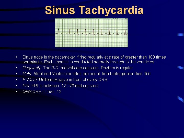 Sinus Tachycardia • • • Sinus node is the pacemaker, firing regularly at a