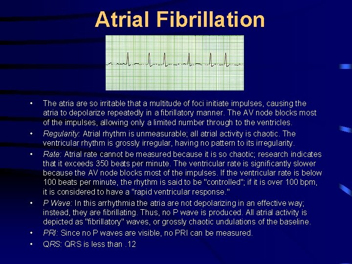 Atrial Fibrillation • • • The atria are so irritable that a multitude of