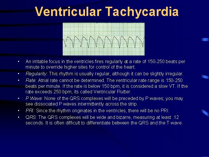Ventricular Tachycardia • • • An irritable focus in the ventricles fires regularly at