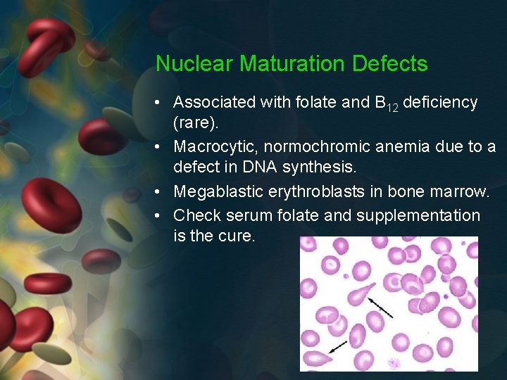 Nuclear Maturation Defects • Associated with folate and B 12 deficiency (rare). • Macrocytic,