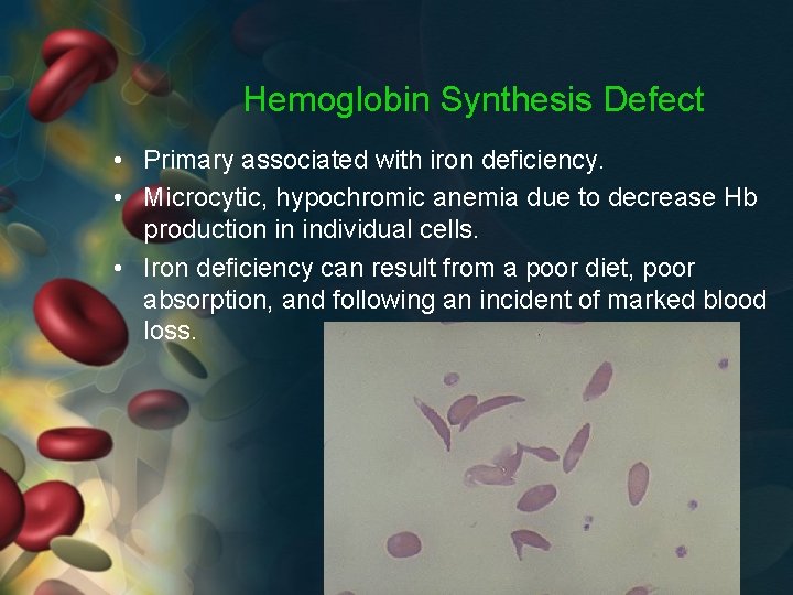 Hemoglobin Synthesis Defect • Primary associated with iron deficiency. • Microcytic, hypochromic anemia due