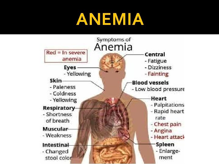 ANEMIA 