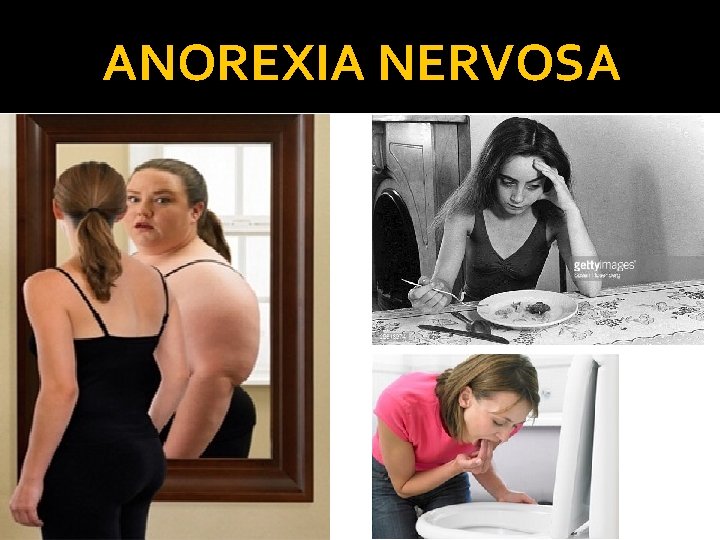 ANOREXIA NERVOSA 