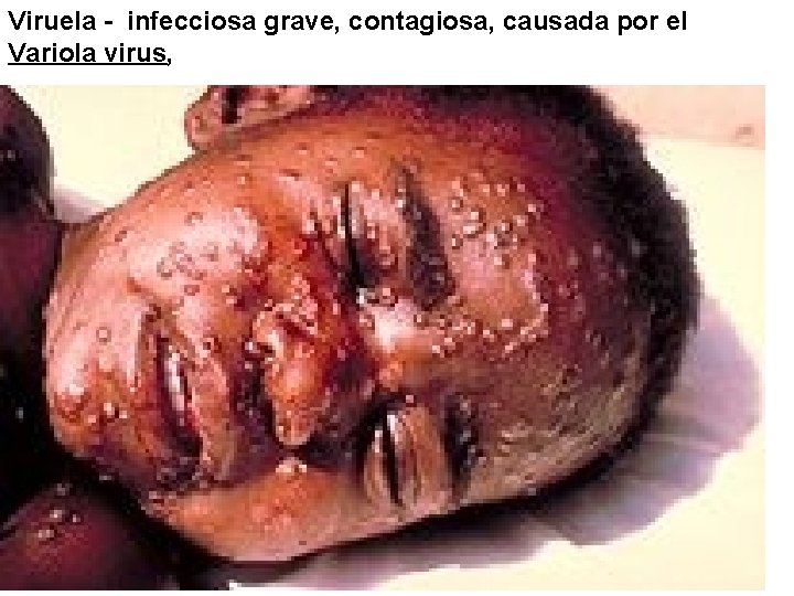 Viruela - infecciosa grave, contagiosa, causada por el Variola virus, 