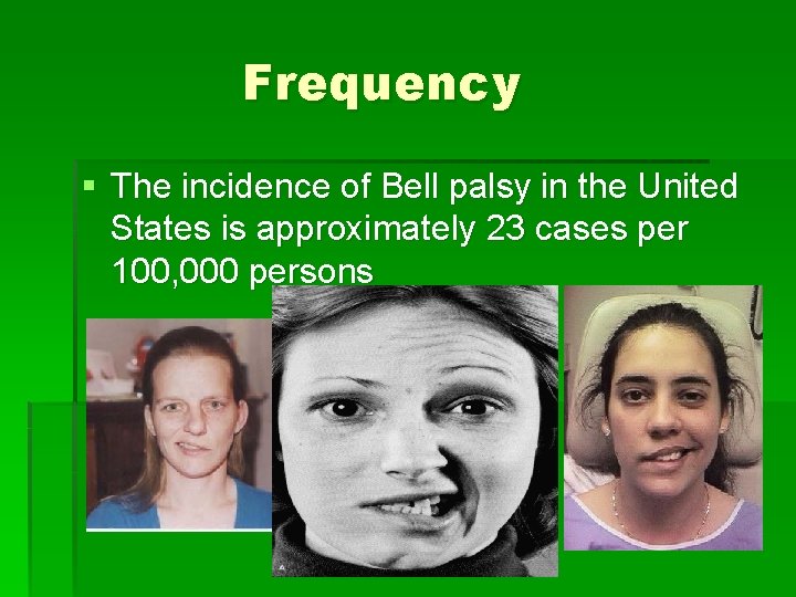 Frequency § The incidence of Bell palsy in the United States is approximately 23