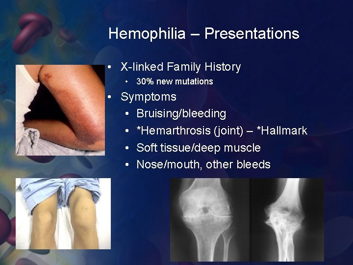 Hemophilia – Presentations • X-linked Family History • 30% new mutations • Symptoms •