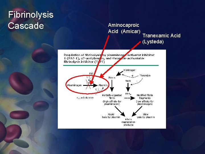 Fibrinolysis Cascade Aminocaproic Acid (Amicar) Tranexamic Acid (Lysteda) 