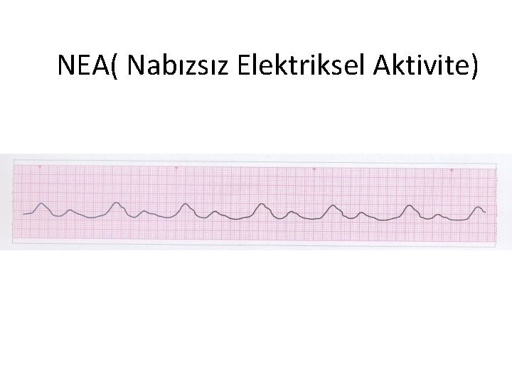 NEA( Nabızsız Elektriksel Aktivite) 