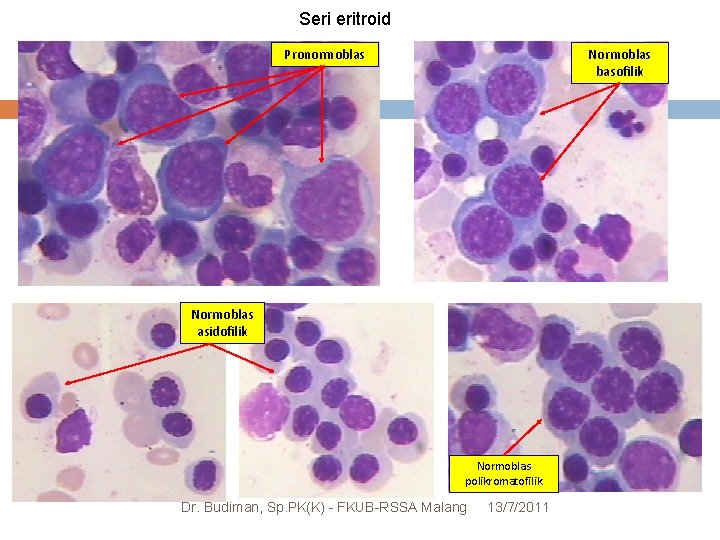 Serieritroid Seri Pronormoblas Normoblas basofilik Normoblas asidofilik Normoblas polikromatofilik Dr. Budiman, Sp. PK(K) -