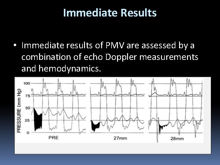 Immediate Results • Immediate results of PMV are assessed by a combination of echo