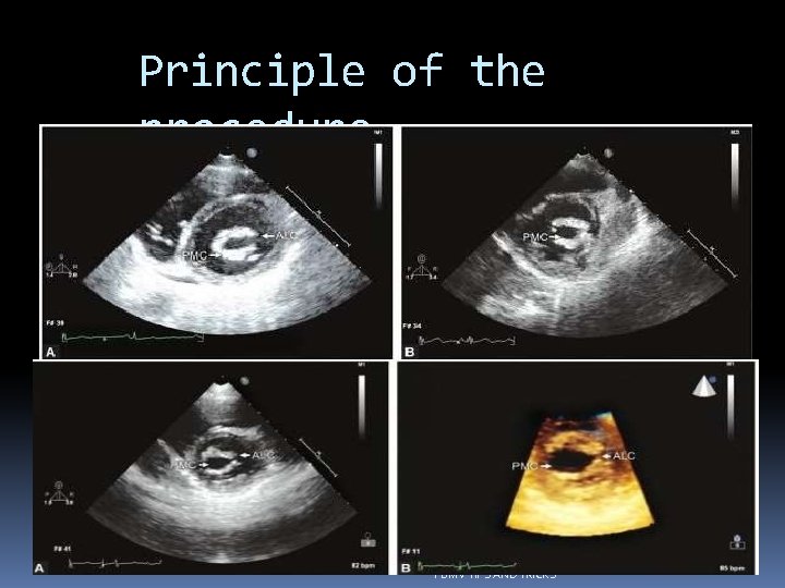 Principle of the procedure PBMV TIPS AND TRICKS 