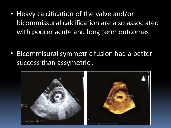  • Heavy calcification of the valve and/or bicommissural calcification are also associated with