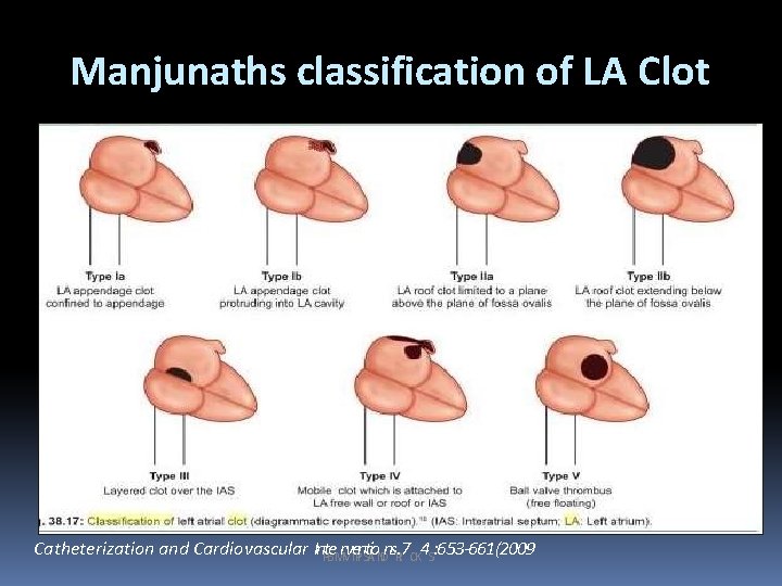 Manjunaths classification of LA Clot Catheterization and Cardiovascular In. Pt. Be. Mr. Vv. Te.