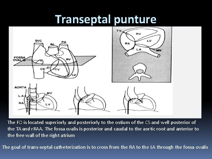 Transeptal punture The FO is located superiorly and posteriorly to the ostium of the
