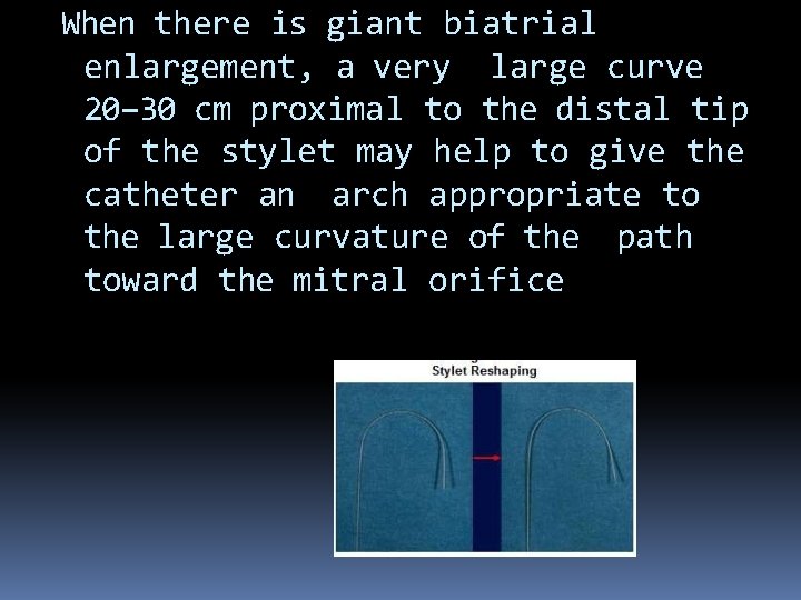 When there is giant biatrial enlargement, a very large curve 20– 30 cm proximal