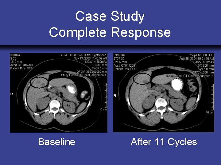 Case Study Complete Response Baseline After 11 Cycles 