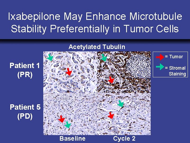 Ixabepilone May Enhance Microtubule Stability Preferentially in Tumor Cells Acetylated Tubulin = Tumor Patient