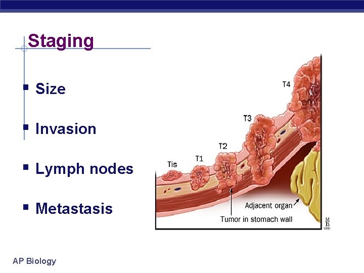 Staging § Size § Invasion § Lymph nodes § Metastasis AP Biology 