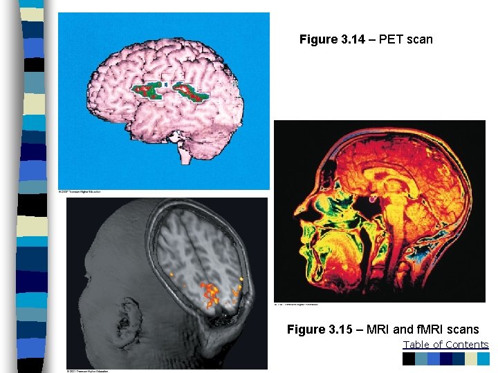 Figure 3. 14 – PET scan Figure 3. 15 – MRI and f. MRI
