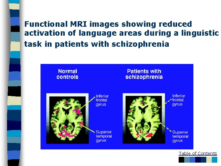 Functional MRI images showing reduced activation of language areas during a linguistic task in