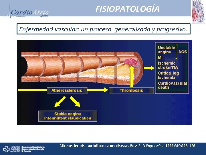 FISIOPATOLOGÍA Enfermedad vascular: un proceso generalizado y progresivo. Atherosclerosis—an inflammatory disease. Ross R. N