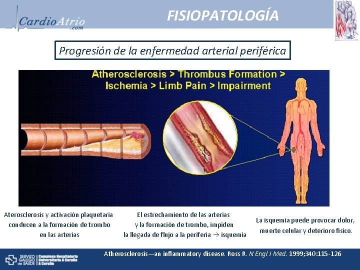 FISIOPATOLOGÍA Progresión de la enfermedad arterial periférica Aterosclerosis y activación plaquetaria conducen a la