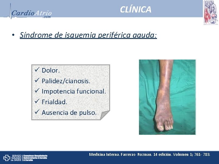 CLÍNICA • Síndrome de isquemia periférica aguda: ü Dolor. ü Palidez/cianosis. ü Impotencia funcional.
