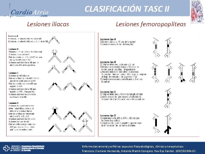 CLASIFICACIÓN TASC II Lesiones ilíacas Lesiones femoropoplíteas Enfermedad arterial periférica: aspectos fisiopatológicos, clínicos y