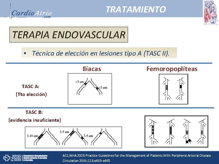 TRATAMIENTO TERAPIA ENDOVASCULAR • Técnica de elección en lesiones tipo A (TASC II). Ilíacas