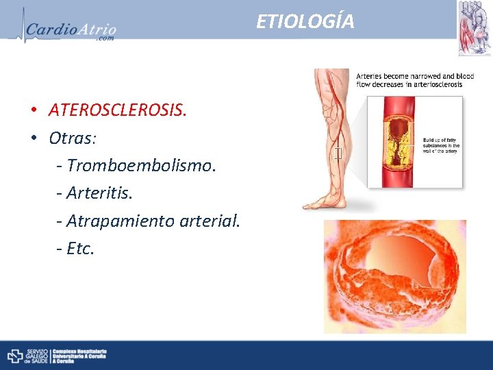 ETIOLOGÍA • ATEROSCLEROSIS. • Otras: - Tromboembolismo. - Arteritis. - Atrapamiento arterial. - Etc.