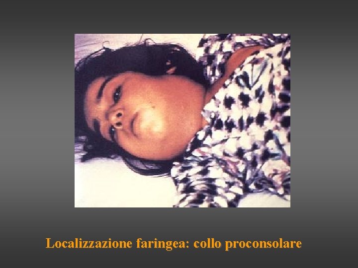 Localizzazione faringea: collo proconsolare 