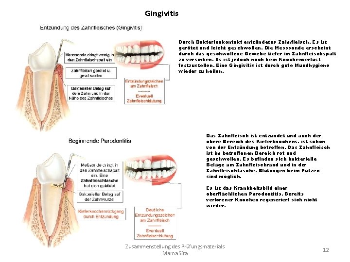 Gingivitis Durch Bakterienkontakt entzündetes Zahnfleisch. Es ist gerötet und leicht geschwollen. Die Messsonde erscheint